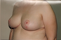Breast Reduction After Photo by Joe Griffin, MD; Florence, SC - Case 22830