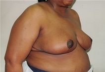 Breast Reduction After Photo by Joe Griffin, MD; Florence, SC - Case 22831