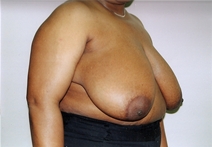 Breast Reduction Before Photo by Joe Griffin, MD; Florence, SC - Case 22831