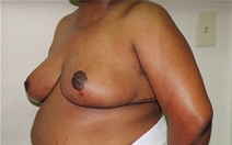 Breast Reduction After Photo by Joe Griffin, MD; Florence, SC - Case 22831