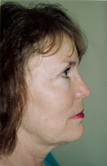 Eyelid Surgery After Photo by Joe Griffin, MD; Florence, SC - Case 22851