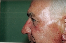 Eyelid Surgery Before Photo by Joe Griffin, MD; Florence, SC - Case 22852
