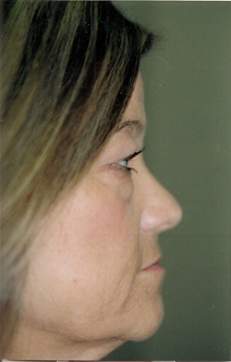 Eyelid Surgery Before Photo by Joe Griffin, MD; Florence, SC - Case 22890