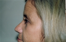 Eyelid Surgery After Photo by Joe Griffin, MD; Florence, SC - Case 22890