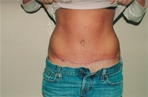 Tummy Tuck After Photo by Joe Griffin, MD; Florence, SC - Case 22891