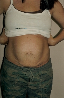 Tummy Tuck Before Photo by Joe Griffin, MD; Florence, SC - Case 22891