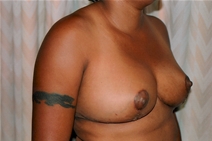 Breast Reduction After Photo by Joe Griffin, MD; Florence, SC - Case 23470