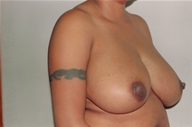 Breast Reduction Before Photo by Joe Griffin, MD; Florence, SC - Case 23470