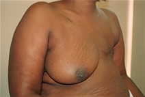 Breast Reconstruction Before Photo by Joe Griffin, MD; Florence, SC - Case 23471