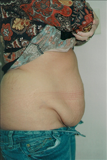 Tummy Tuck Before Photo by Joe Griffin, MD; Florence, SC - Case 24079