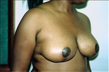 Breast Reduction After Photo by Joe Griffin, MD; Florence, SC - Case 24085