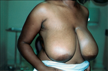 Breast Reduction Before Photo by Joe Griffin, MD; Florence, SC - Case 24085