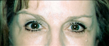 Eyelid Surgery After Photo by Joe Griffin, MD; Florence, SC - Case 24257