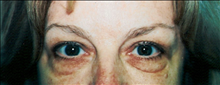 Eyelid Surgery Before Photo by Joe Griffin, MD; Florence, SC - Case 24257