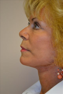 Facelift After Photo by Joe Griffin, MD; Florence, SC - Case 24415