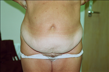Tummy Tuck Before Photo by Joe Griffin, MD; Florence, SC - Case 24416