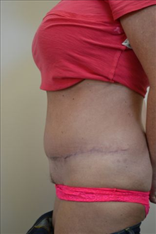 Tummy Tuck After Photo by Joe Griffin, MD; Florence, SC - Case 24416