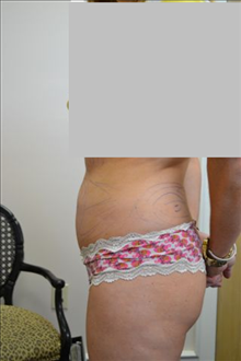 Liposuction Before Photo by Joe Griffin, MD; Florence, SC - Case 24844