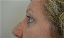 Eyelid Surgery After Photo by Joe Griffin, MD; Florence, SC - Case 24849