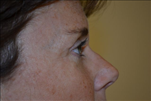 Eyelid Surgery After Photo by Joe Griffin, MD; Florence, SC - Case 24850