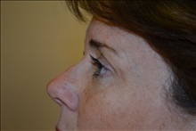 Eyelid Surgery After Photo by Joe Griffin, MD; Florence, SC - Case 24850
