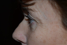 Eyelid Surgery Before Photo by Joe Griffin, MD; Florence, SC - Case 24850