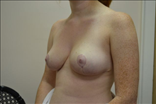 Breast Reduction After Photo by Joe Griffin, MD; Florence, SC - Case 24959