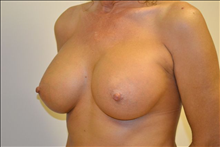 Breast Augmentation After Photo by Joe Griffin, MD; Florence, SC - Case 24962