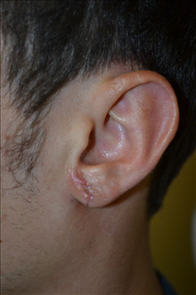 Ear Surgery After Photo by Joe Griffin, MD; Florence, SC - Case 24963