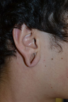 Ear Surgery Before Photo by Joe Griffin, MD; Florence, SC - Case 24963