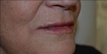 Dermal Fillers After Photo by Joe Griffin, MD; Florence, SC - Case 25084