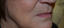 Dermal Fillers Before Photo by Joe Griffin, MD; Florence, SC - Case 25084