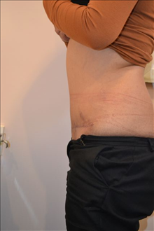 Tummy Tuck After Photo by Joe Griffin, MD; Florence, SC - Case 25088