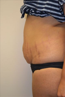 Tummy Tuck Before Photo by Joe Griffin, MD; Florence, SC - Case 25088