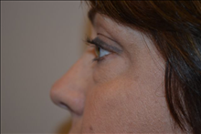 Eyelid Surgery Before Photo by Joe Griffin, MD; Florence, SC - Case 25089