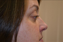 Eyelid Surgery After Photo by Joe Griffin, MD; Florence, SC - Case 25089