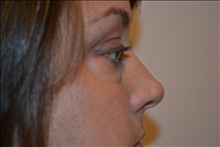 Eyelid Surgery Before Photo by Joe Griffin, MD; Florence, SC - Case 25089