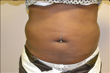 Liposuction Before Photo by Joe Griffin, MD; Florence, SC - Case 25155
