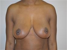 Breast Lift After Photo by Joe Griffin, MD; Florence, SC - Case 25835