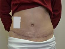 Tummy Tuck After Photo by Joe Griffin, MD; Florence, SC - Case 25836