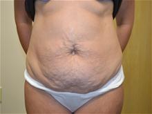 Tummy Tuck Before Photo by Joe Griffin, MD; Florence, SC - Case 25836