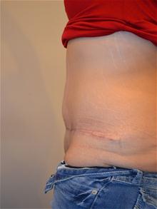 Tummy Tuck After Photo by Joe Griffin, MD; Florence, SC - Case 25844