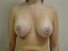 Breast Augmentation After Photo by Joe Griffin, MD; Florence, SC - Case 29389