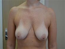 Breast Augmentation Before Photo by Joe Griffin, MD; Florence, SC - Case 29389