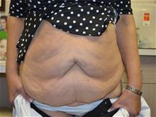Tummy Tuck Before Photo by Joe Griffin, MD; Florence, SC - Case 29391