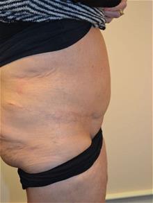 Tummy Tuck After Photo by Joe Griffin, MD; Florence, SC - Case 29391