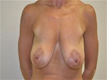 Breast Lift Before Photo by Joe Griffin, MD; Florence, SC - Case 29392