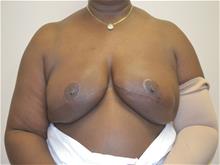 Breast Reconstruction After Photo by Joe Griffin, MD; Florence, SC - Case 29394