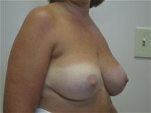 Breast Reduction After Photo by Joe Griffin, MD; Florence, SC - Case 29396