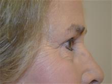 Eyelid Surgery After Photo by Joe Griffin, MD; Florence, SC - Case 29397